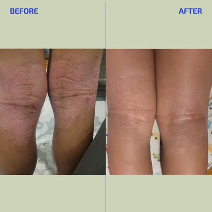 BIA Eczema Relief Lotion