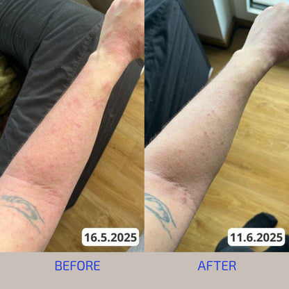 Skin Barrier Eczema Relief System (Adult: 18+)