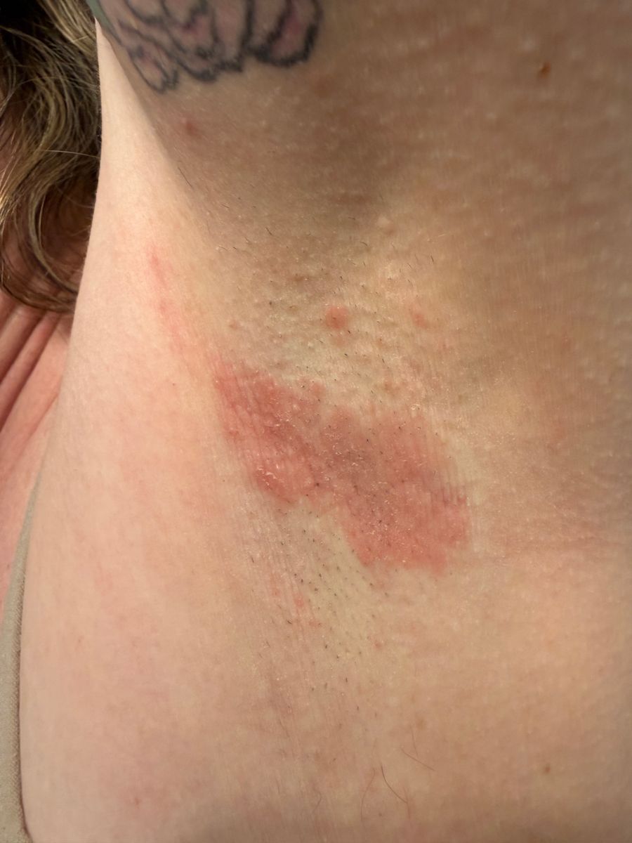 Customer photo showing a red, irritated rash on the underarm before using MAGS Skin